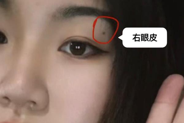 右眼周围痣相,右眼附近的痣