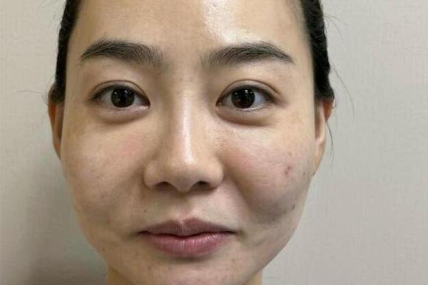 苹果肌上面的痣相—苹果肌上面有个沟叫什么