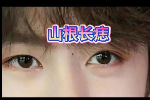 男人山根有痣相代表什么—男山根有痣真的不好吗 男人山根有痣相代表什么—男山根有痣真的不好吗