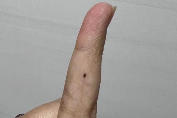 手指痣相-小手指长痣的位置和命运