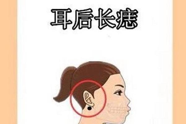痣相耳后(耳朵后长痣的位置图解)
