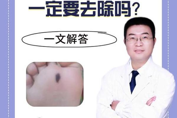 脚外侧痣相;脚外侧边缘痣图解