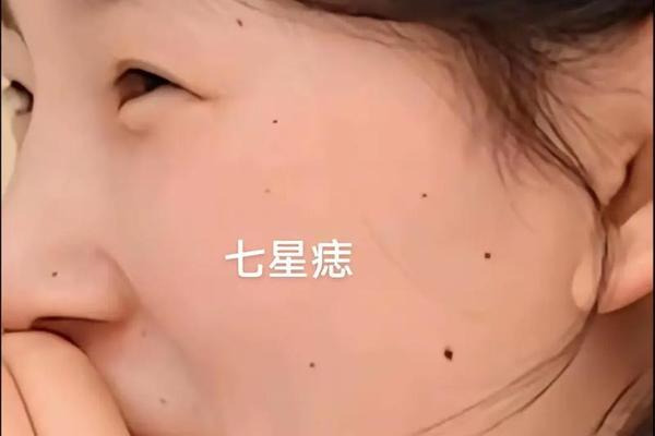 痣相的北斗七星-七星护体的痣在哪个部位