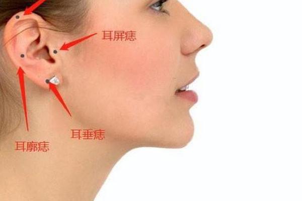 痣相耳内,耳朵内耳廓有痣