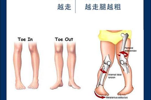走路内八字