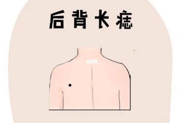 背痣相大全;背后的痣相图解大全