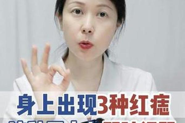 肚子长红痣痣相-肚子长红痣是什么征兆
