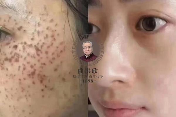 后背长朱砂痣相_背上朱砂痣的含义