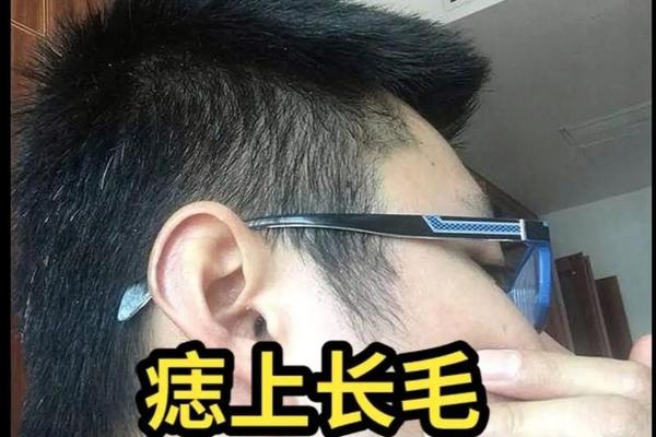 麻衣神相痣上长毛 长毛痣代表什么意思
