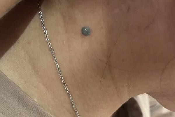 痣相女人脖子上痣(脖子两侧有痣的女人代表什么)
