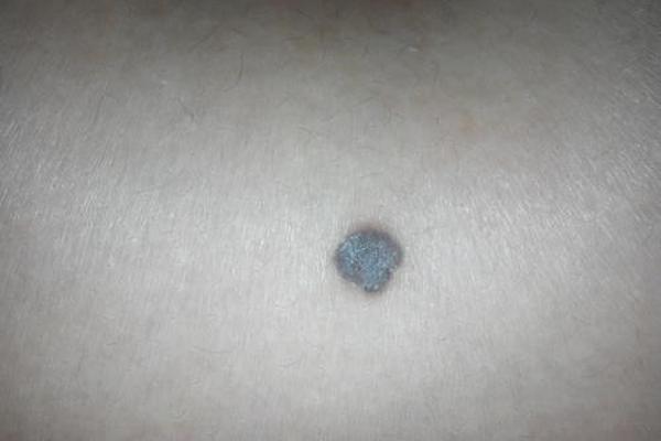 大腿有痣之痣相详解-大腿前面有痣代表什么意思 大腿有痣之痣相详解-大腿前面有痣代表什么意思