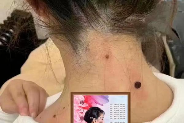 脖子有痣相女生、女生脖子的痣图解命运