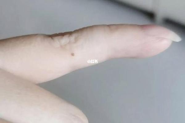 小拇指长痣痣的相法_小拇指长痣的位置和命运