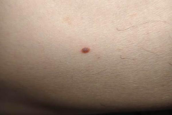 成功男人的痣相、男人大腿内侧有巨富痣
