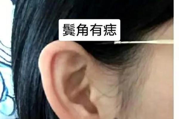 女发际线痣相_女人发际线边缘有痣 女发际线痣相_女人发际线边缘有痣