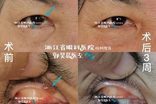 上眼睑痣相_眼睑内有痣的人
