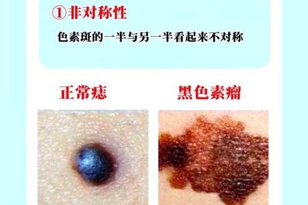 身上哪些痣不好体相_身上什么样的痣需要注意
