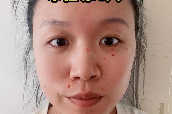 苏州相城人民医院点痣-苏州哪里点痣最好的医院