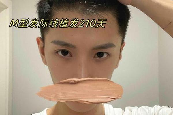发际线黄金痣相—天生发际线高能植发吗