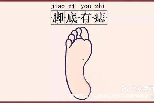 足底生痣相;脚底长痣的痣相图解