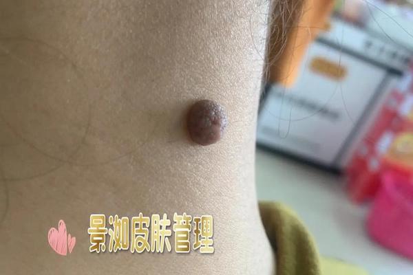 痣相男颈、脖子有痣代表什么 痣相男颈、脖子有痣代表什么