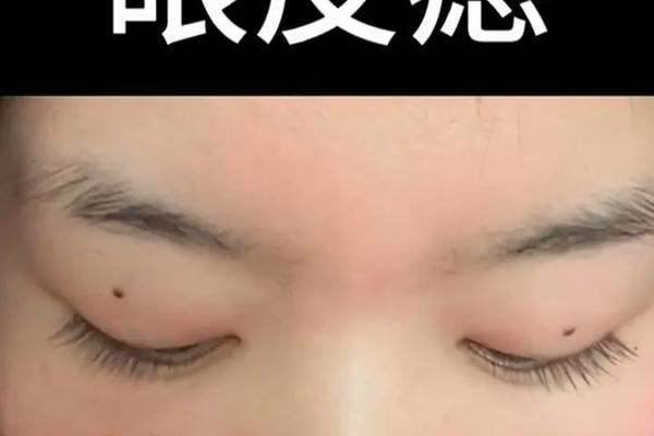 痣相眼睑;眼皮上痣叫什么