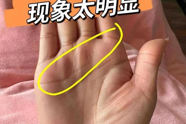 元宝纹掌相有个痣的女人 手上有元宝纹的女人