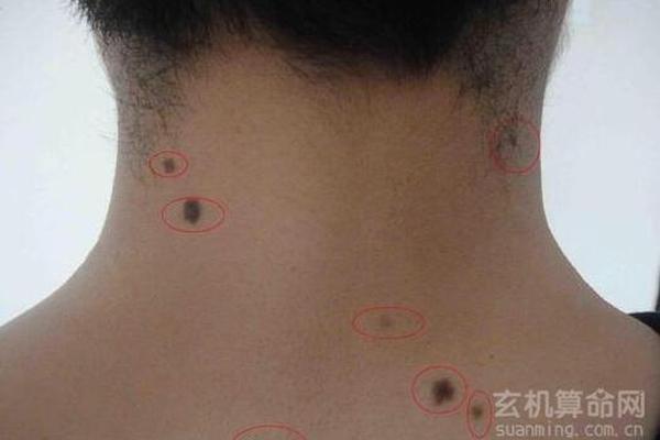女人后颈脖子中间的痣相_脖后有痣的女人好不好