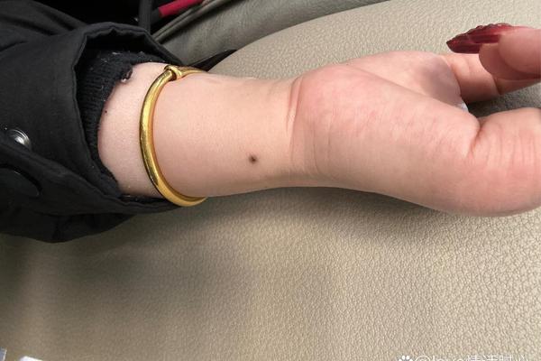 手腕上的痣相详解,男人手腕有痣图解大全 手腕上的痣相详解,男人手腕有痣图解大全