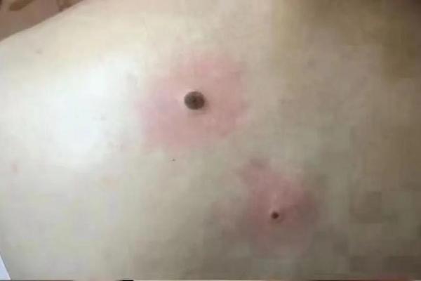 男人后背部痣相最准图-后背有痣命苦 男人后背部痣相最准图-后背有痣命苦