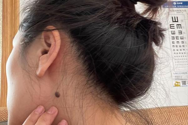 痣相女脖子中间—脖子痣 痣相女脖子中间—脖子痣