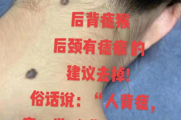 后脑勺痣相富贵、后脑勺的痣是什么意思