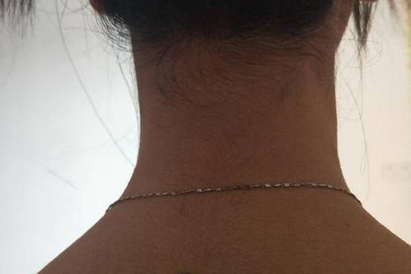 背部有痣相的女人_女人后背有痣命苦是吗 背部有痣相的女人_女人后背有痣命苦是吗
