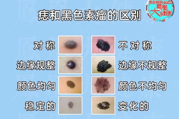 坏痣相-什么样的痣是好痣和坏痣