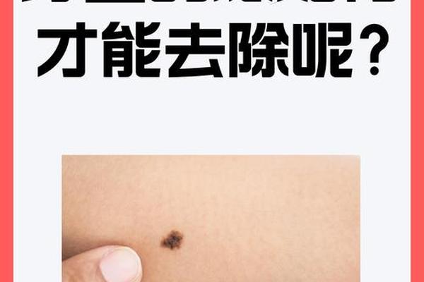 痣相不好需要祛除吗_痣相不好可以点掉吗 痣相不好需要祛除吗_痣相不好可以点掉吗