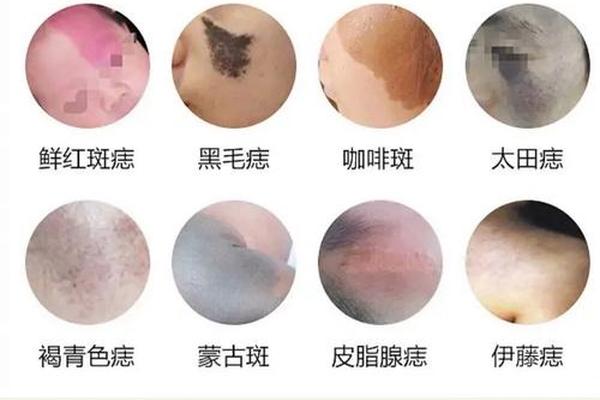 胎记图片大全图解 痣相—好看的胎记图片