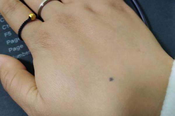 手背相痣图解男生 男人手背上的痣的位置与命运图解