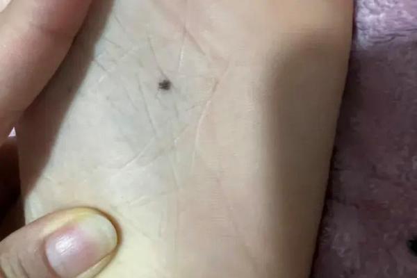 右脚相脚底板有痣—右脚脚心长痣代表什么