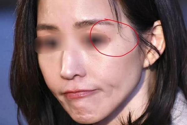 女左夫妻宫痣痣相_女孩左右夫妻宫有痣