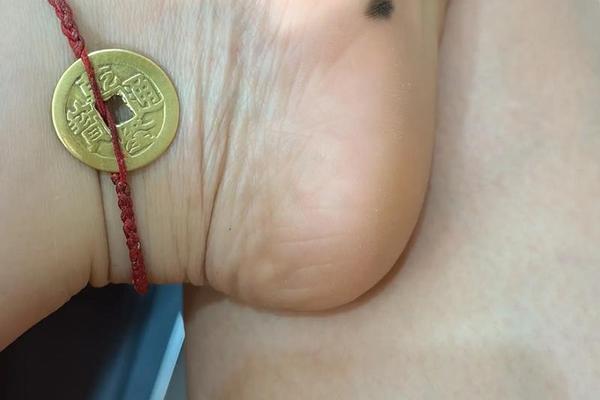 痣相女人脚趾头痣相图解-面相痣的图片大全