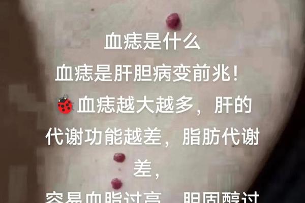 血痣水镜神相—血痣有什么寓意