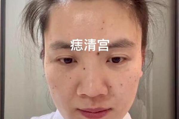 瘢痕痣相,疤会不会变成痣