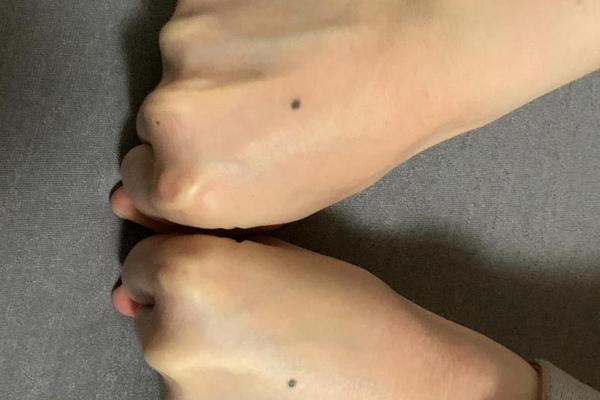 女人手背痣相算命图解,女人手背上长痣图解大全 女人手背痣相算命图解,女人手背上长痣图解大全