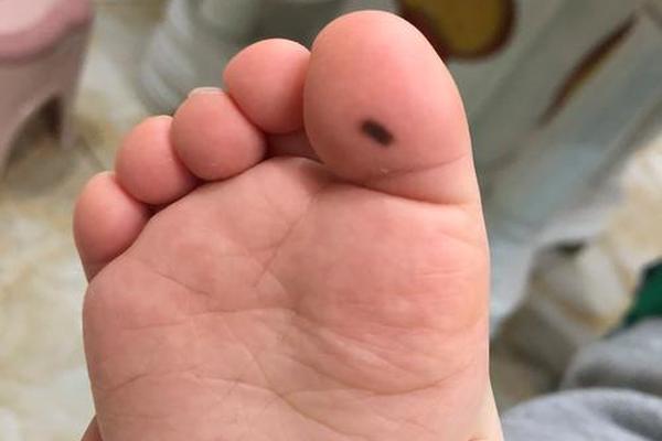 右脚大拇指头有痣图相_右脚大拇指上有痣代表