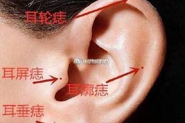 耳下有痣相_耳朵痣与命运的关系 耳下有痣相_耳朵痣与命运的关系