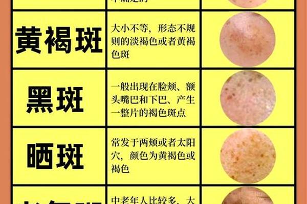 黄褐斑痣相,黄褐斑特征和形状 黄褐斑痣相,黄褐斑特征和形状