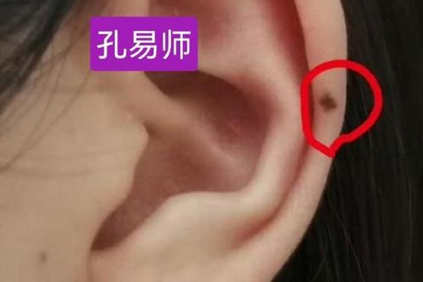 相法耳内痣主 内耳轮有痣代表什么