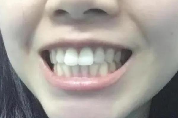 门牙八字 门牙八字