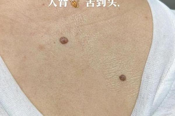 腰背长痣相(后腰背有痣图解)