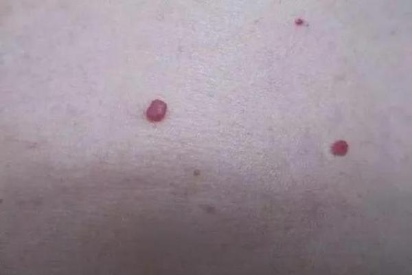 痣相女 身体红痣(女人身上长红痣好不好)